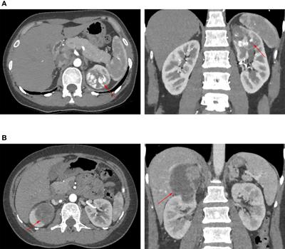 Comparison of Transperitoneal and Retroperitoneal Robotic Partial Nephrectomy for Patients With Complete Upper Pole Renal Tumors